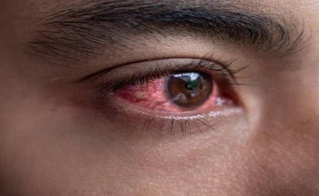 आई फ्लू : लक्षण दिखते ही तुरंत संपर्क करें चिकित्सक से, बरतें सावधानी